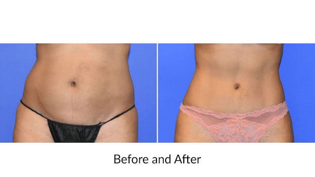 Before and after: Tummy Tuck